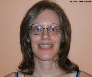 Marie-Hélène Cyr - Après des chirurgies orthognatiques (5 juin 2008)